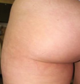 <strong>Stretch Mark Reduction</strong>