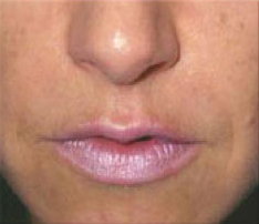 Cosmetic Fillers