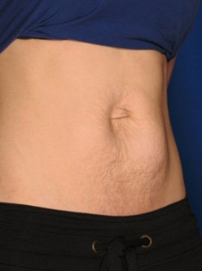 <strong>Stretch Mark Reduction</strong>