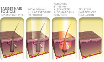 Laser Hair Removal Treatment in Marlboro Manalapan Freehold