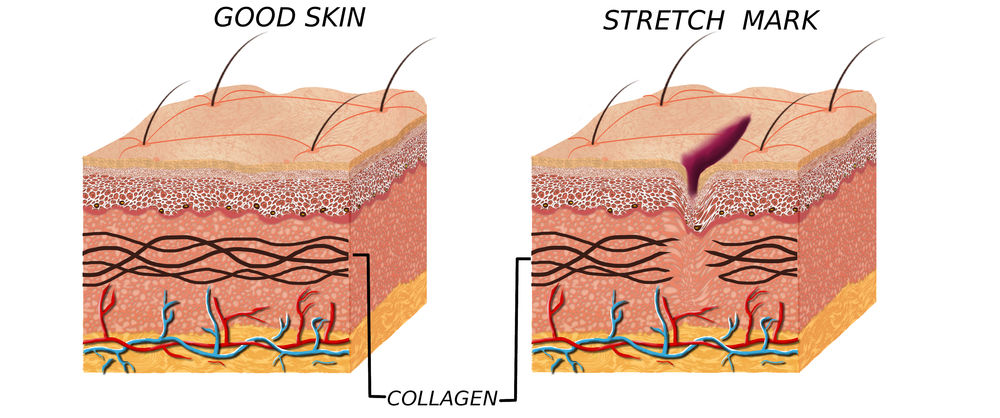 What to Do About Stretch Marks - Spa MDSpa MD